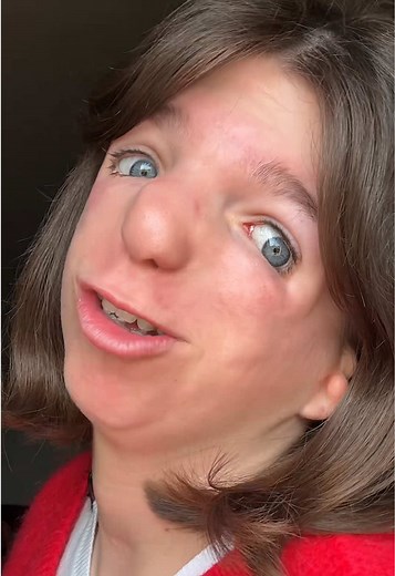 Treachers Collins syndrome humour playback video