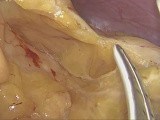 Low Anterior Resection with Partial Mesorectal Excision - Complete - No Edition • Video • MEDtube.net