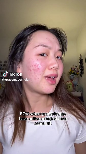 Winning the Battle Against Acne Scars: A Journey to Clear Skin