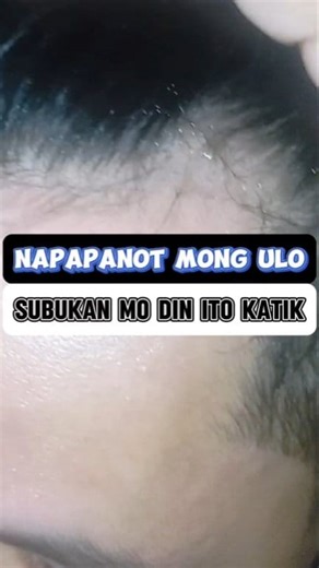 No More Panot Spot Mga KaTikTik! Effective and Proven by Us ! #drlan #hairgrowth #hairgrowthtips #reelsviralシfb #madamtiktiktv | Madam TikTik TV