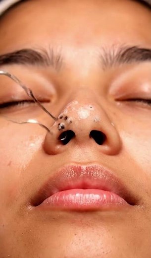 ASMR T-Zone Deep Cleansing Facial | Realistic Blackhead & Sebum Extraction | Forehead