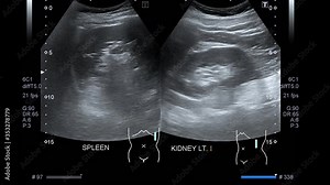 Ultrasound scan medical imaging of abdomen showed bladder.
