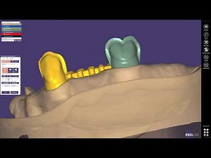 L5CAD Kurztutorial Kronen im exocad verbinden