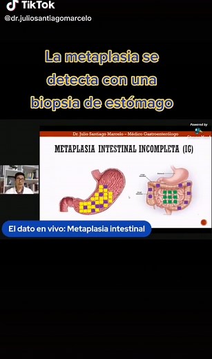 La metaplasia intestinal no genera dolor y puede ser completa o incompleta #gastroenterologo #gastroenterologoperu #metaplasiaintestinal #metaplasia #medicosperuanos