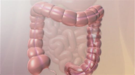 What colon cancer screening may be right for you