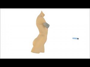Senella: engineered resorbable breast implant made by Additive Manufacturing