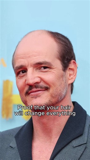 Hair is just a part of our identity, nothing wrong with being bald tho but today you have the option. #hairtransplant #hairtransformation #hair #celebrity