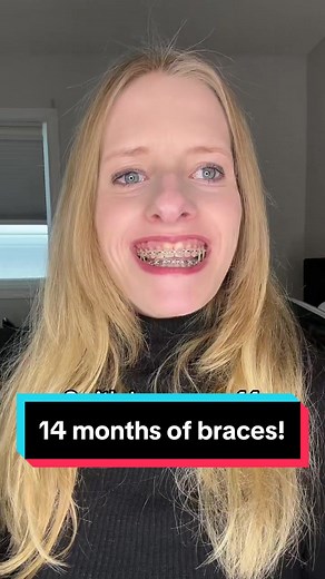 Journey of My Braces: 14 Months Progress Update