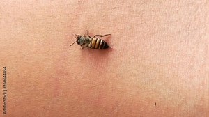 Close up of the bee sting in human skin and rip out the sting. Attack of a honeybee.