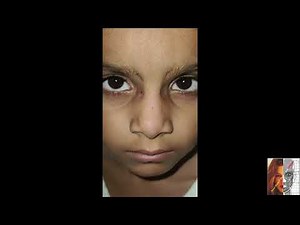 Recurrent rupture of a dorsal nasal dermoid cyst at both canthi-Total Excision