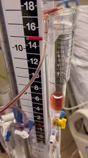 Understanding Intracranial Pressure Monitoring Devices for Neuro ICU Nurses