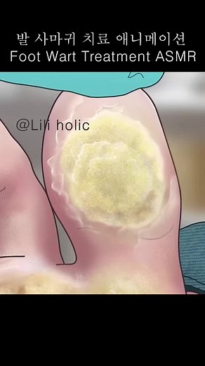 사마귀 제거를 위한 발가락 사이 꿀팁
