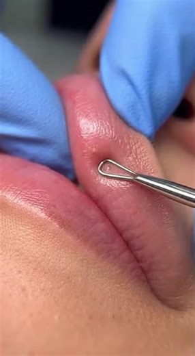 black heads remove for lips. #viral #faceclean #creatorsearchinsights #facecleaning #removeblackheads