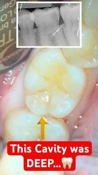 Deep Class II Cavity Restoration… What Was Hidden Inside This Tooth 😳🦷