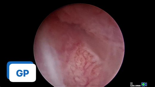 Extraction of copper iud with base in the tubal ring . | gaetano perrini