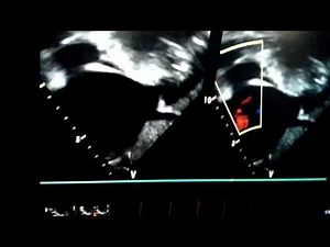 Sinus venosus ASD echocardiography