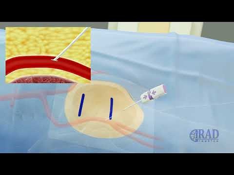Active arterial access closure device (Angioseal)