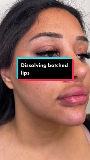 Dissolving botched lips for a BIG transformation! #botched #biglips #fillersinjection #fillergonewrong #hyalase #dissolve