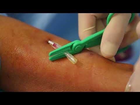 Ponction fistule avec technique Buttonhole