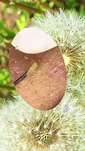 Spa pustule on TikTok