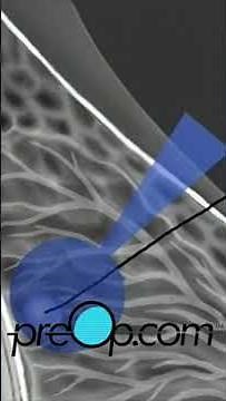 🔍 PreOp® Wire Localization Breast Biopsy Patient Ed 💡What Every Pro Should Know✨ #shorts