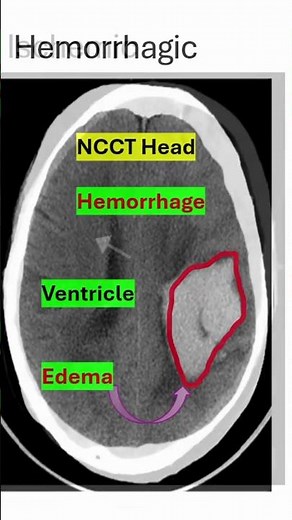 Hemorrhagic vs Ischemic Stroke | Quick Imaging Recall