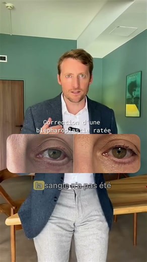 Oeil rond après blépharoplastie : causes, prévention et solutions | Dr. Koppe
