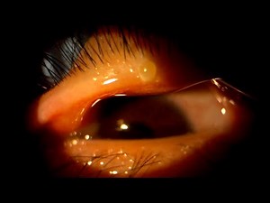 Conservative treatment of a chalazion