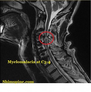 Hoffmann Sign and Myelopathy - ShimSpine