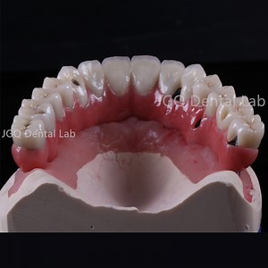 [Hot Item] Customize Full Arch Dentures Bridge All on 4 Dental Implants Layered Zirconia