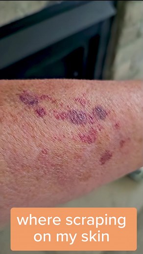 245 reactions · 24 shares | Real review of the Helichrysum Balm | Vitality Extracts Essential Oils | Facebook