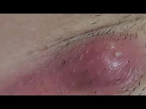 REMOVE A BOIL QUICK AND EASY