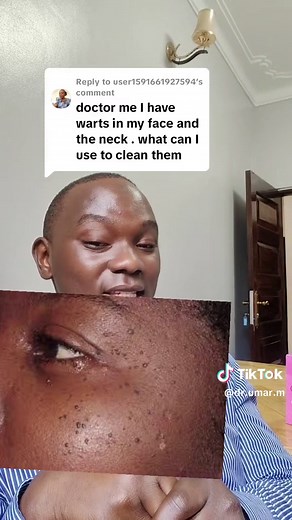 Replying to @user1591661927594 Dermatosis papulosa nigra (DPN) is a benign epidermal growth that presents as hyperpigmented or skin-colored papules that develop on the face and neck beginning in adolescence. It typically occurs in individuals with Fitzpatrick skin types III to VI, most commonly affecting people of African and Asian descent. It is considered to be a common variant of seborrheic keratoses. management. -snip excision. -CO2 ablative laser. -electrocautery. #dermatologist #journeytoa