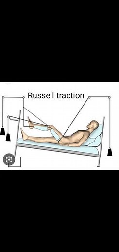 Buck's V/S Russell traction
