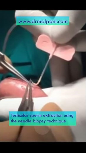 Testicular Sperm Extraction using the Fine needle biopsy technique