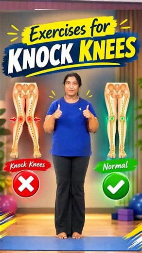 Knock Knee Exercises: 6 Simple Exercises to Improve Knee Alignment & Leg Strength