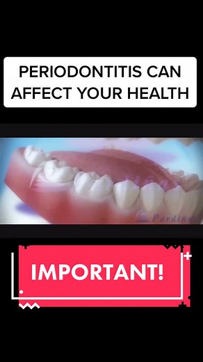 🦷Periodontitis or periodontal disease can affect your overall health. #periodontitis #periodontaldisease #dentistry