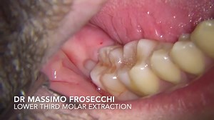 horizontal lower third molar extraction