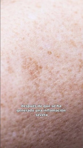 HIPERPIGMENTACIÓN POSTINFLAMATORIA: Tratamientos para tratar las MANCHAS 😲✨ #cuidadodelapiel