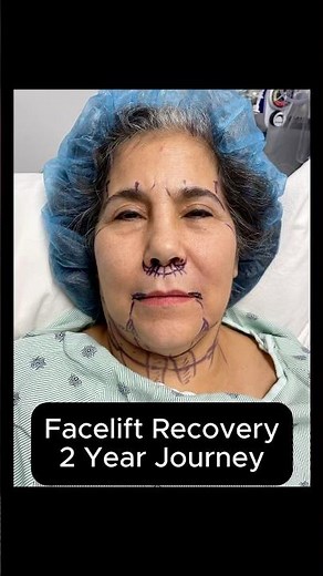 Natural Facelift Transformation - 2 Year Journey #facelift