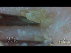 #11 Continuous Removal of Blackheads Close up - Squeezing Blackheads