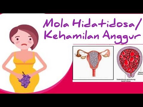Mengenal Mola Hidatidosa / Kehamilan Anggur