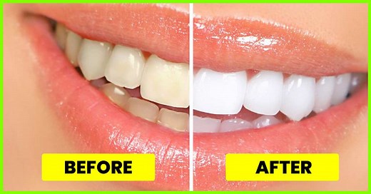 How To Whiten Teeth At Home: 16 Easy Overnight Remedies
