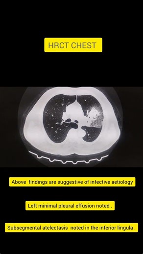 HRCT CHEST #radiography #anatomy #reels #biology