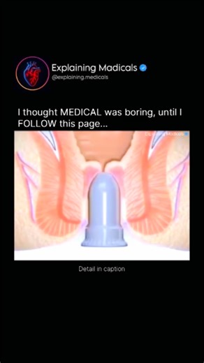 Medical | Health | Anatomy on Instagram: "Stapler surgery, medically called stapled hemorrhoidopexy, is a modern treatment for hemorrhoids (piles) that focuses on fixing the problem from inside rather than cutting the painful outer skin. In this procedure, a special circular stapling device is used to gently lift the prolapsed hemorrhoidal tissue back to its normal position inside the rectum. At the same time, a thin ring of excess tissue is removed, and the area is sealed with tiny titanium sta