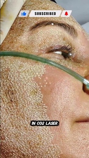 UltraPulse Alpha | Gold Standard CO2 Rejuvenation