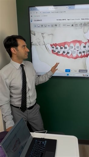 Imagine braces… but smarter. Like, AI-powered smarter. 🤯 That’s exactly what local orthodontist Dr. Mehdi Peikar has created with Celebrace! It’s a groundbreaking system that customizes every single step of your treatment for faster, more precise results. Here’s why it’s a total game-changer: 🦷 Custom Wires → Each tooth gets exactly the right amount of force (because molars are very different than front teeth!). 🦷 3D Printed Brackets → Designed to fit each tooth perfectly = fewer breakages fe