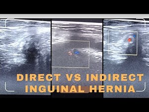 Ultrasound Guide: How to Distinguish Direct and Indirect Inguinal Hernias.