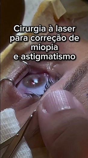 Cirurgia à laser para correção de miopia e astigmatismo