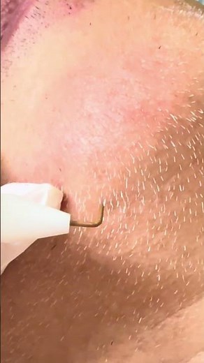 無痛でニードル脱毛可能な唯一のクリニック#麻酔科専門医
